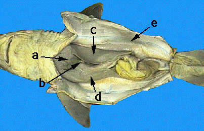 folded gallbladder