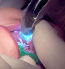 ART light cured