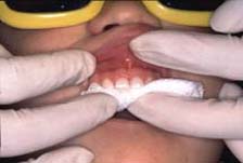 fluoride varnish