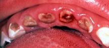 gross decay