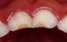 enamel hypoplasia