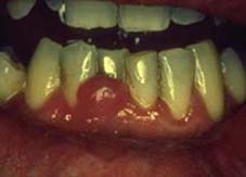 pyogenic granuloma
