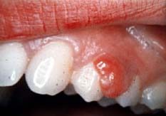 pyogenic granuloma