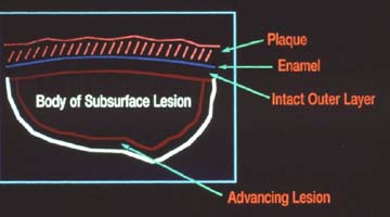 subsurface lesion