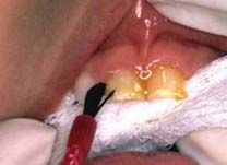 fluoride varnish