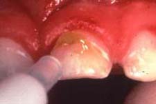 fluoride varnish