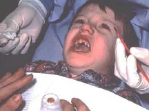 fluoride varnish