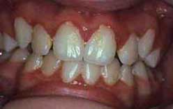 Pregnancy Gingivitis